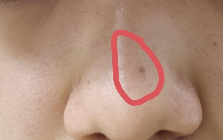 美容院清洁黑头会让毛孔变大吗,黑头拔了毛孔变大会自己愈合吗