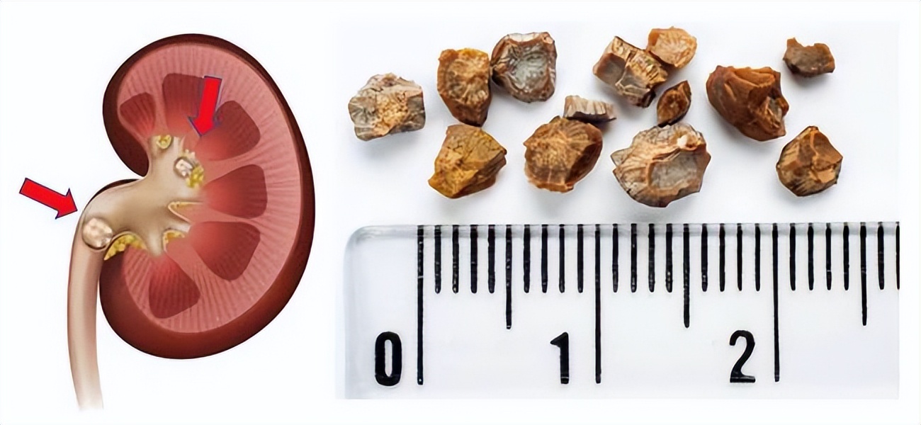 输尿管结石体外碎石多久能排出来,为什么做了体外碎石不尿血