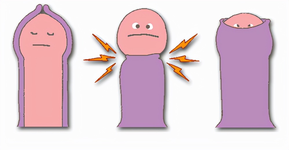 25岁包皮过长有必要手术吗,成年人包皮过长的患者多不多