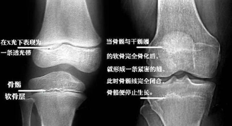 骨骺线不完全闭合啥意思,骨骺线闭合不可逆