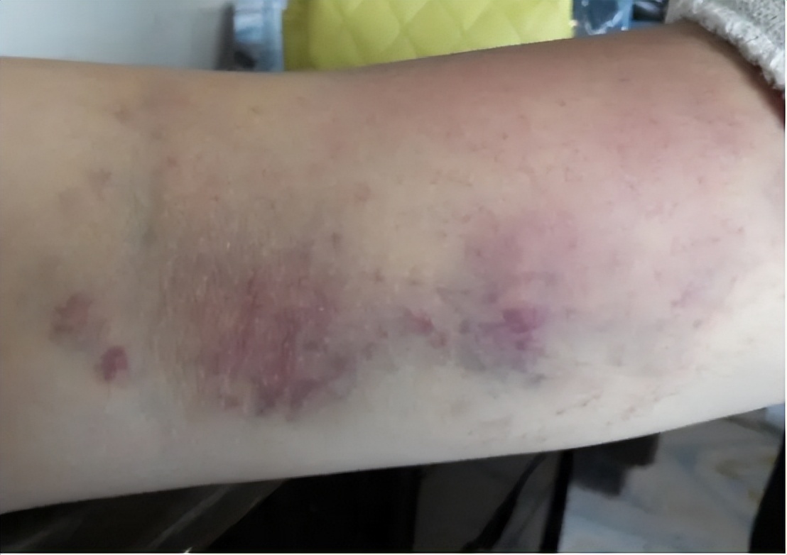 筋膜枪的危害和副作用,电筋膜枪有什么副作用