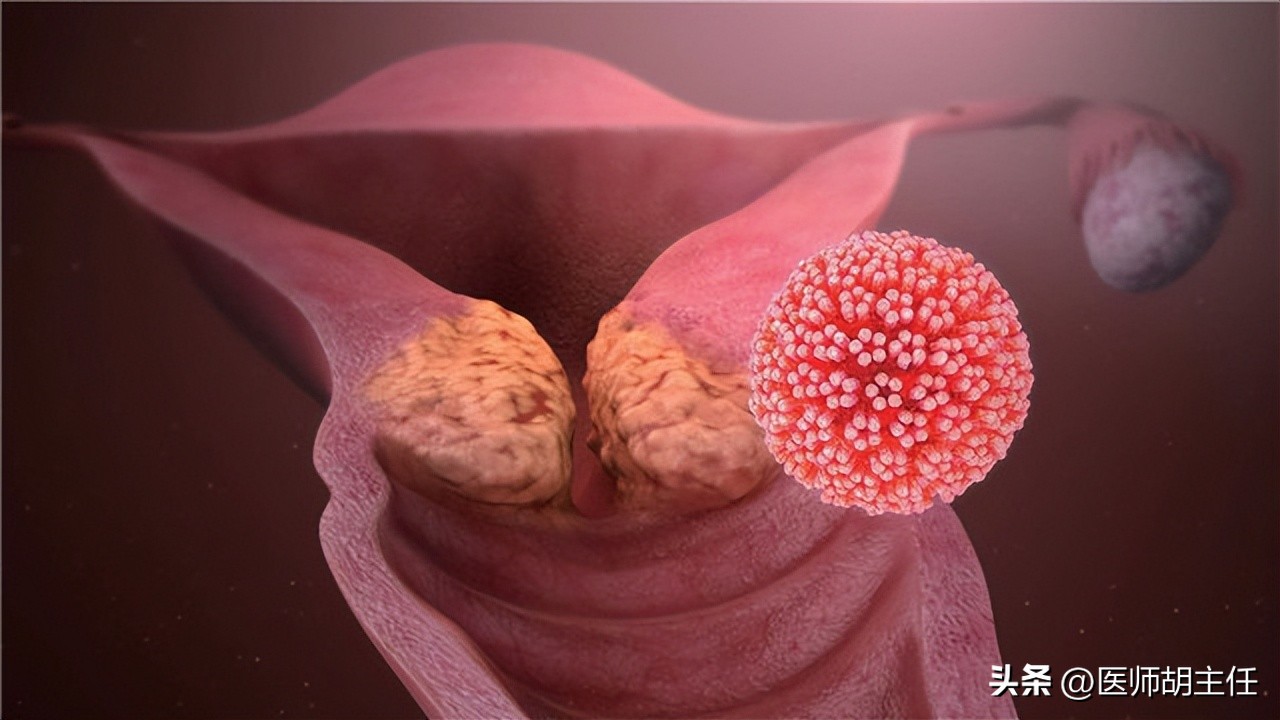 宫颈癌的前兆会不会腿痛,宫颈癌有一项异常会怎样