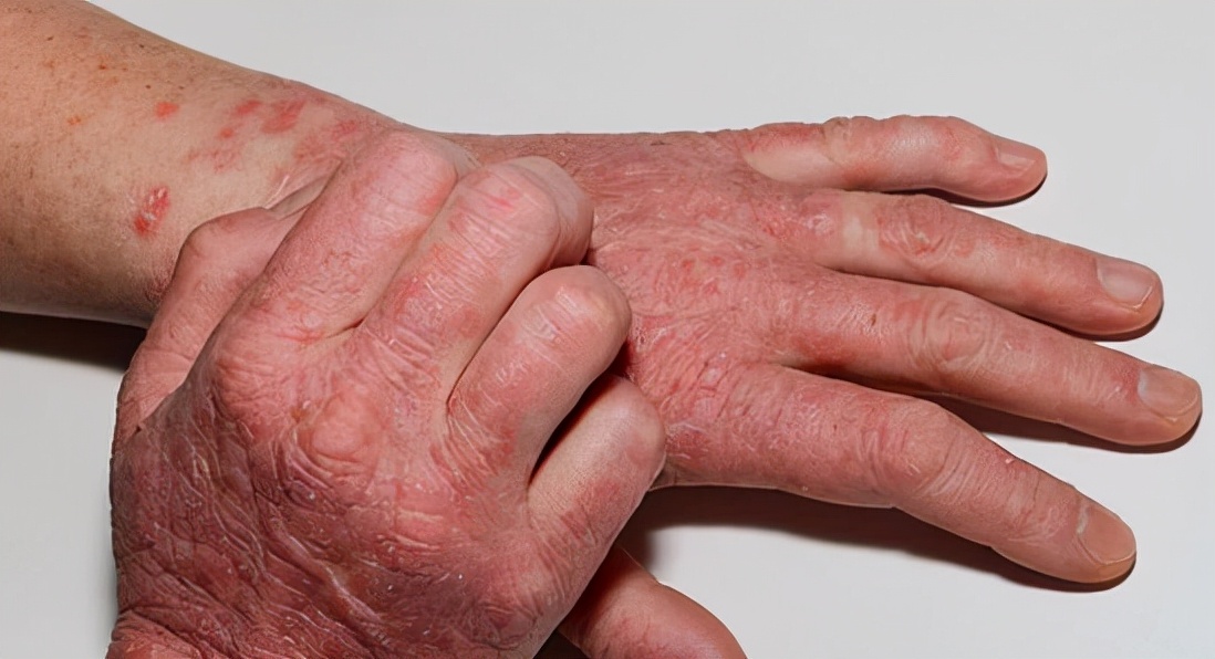 慢性湿疹痒起来要命,湿疹好多年不好现在好痒怎么治