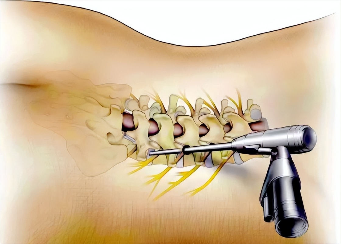 腰椎内镜术后做什么锻炼最好,腰椎手术后的护理问题及护理措施