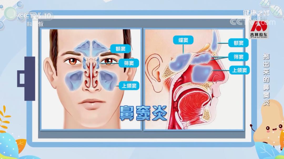 鼻窦炎手术切除了一块骨头,鼻窦炎手术后患者