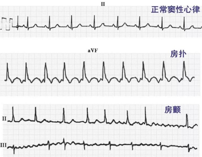 确定全麻手术后马匹心律失常的患病率和性质，评估心律失常的风险