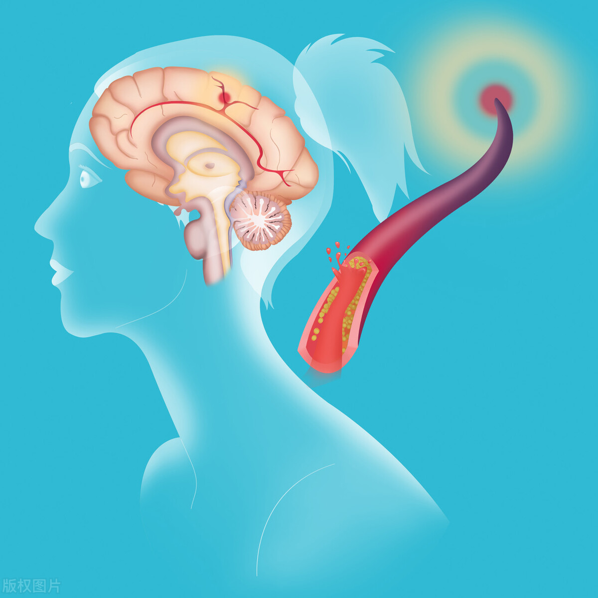 头皮堵塞会引发脑梗吗,头部血管病变有什么症状