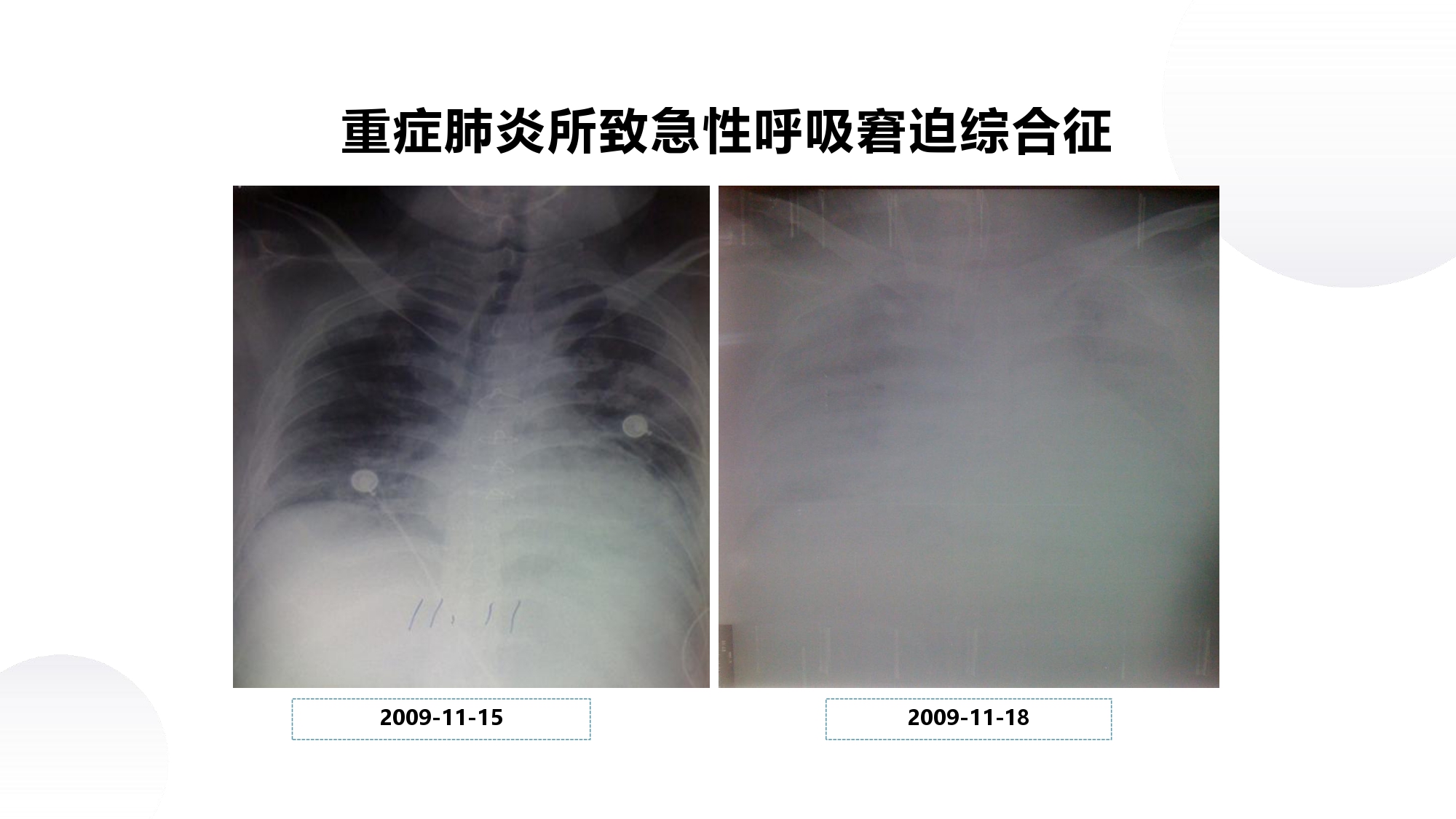 呼吸内科教学课件分享｜第十四章何为急性呼吸窘迫综合征？