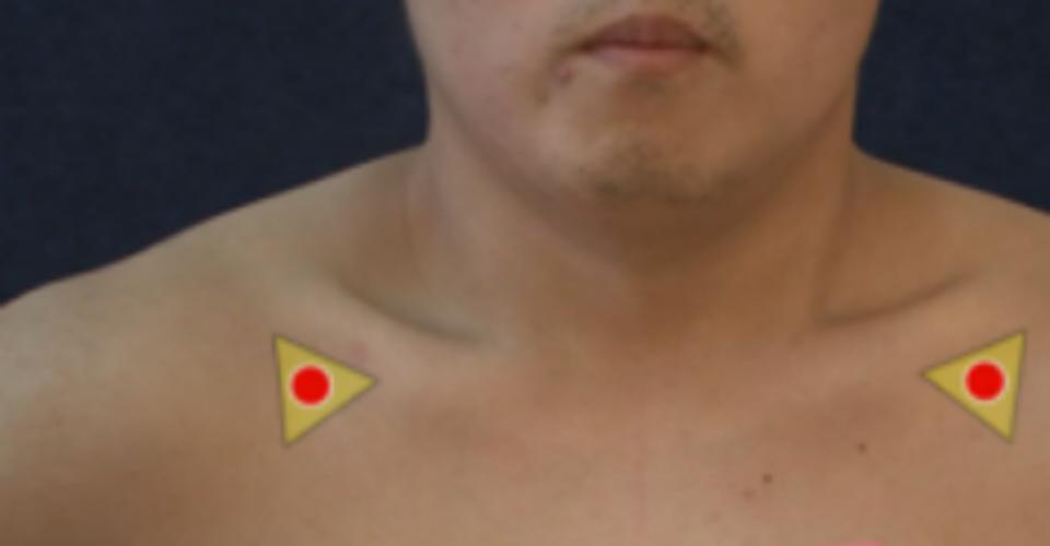 云门穴丰隆穴,云门穴有宣肺功能吗