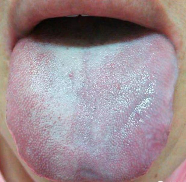 痰瘀型冠心病吃什么祛痰,冠心病痰湿中成药