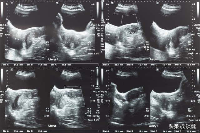 子宫肌瘤恶性的后果,子宫肌瘤特别大有危险吗怎样治疗