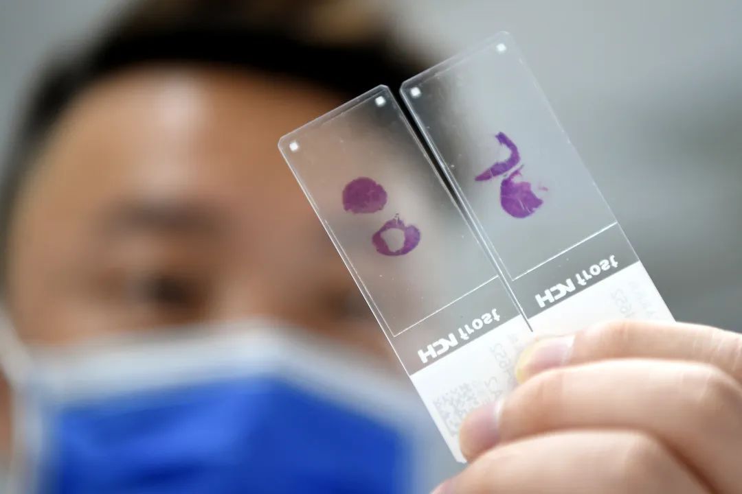 医生说病理报告有点小问题,病理报告没出来好害怕啊