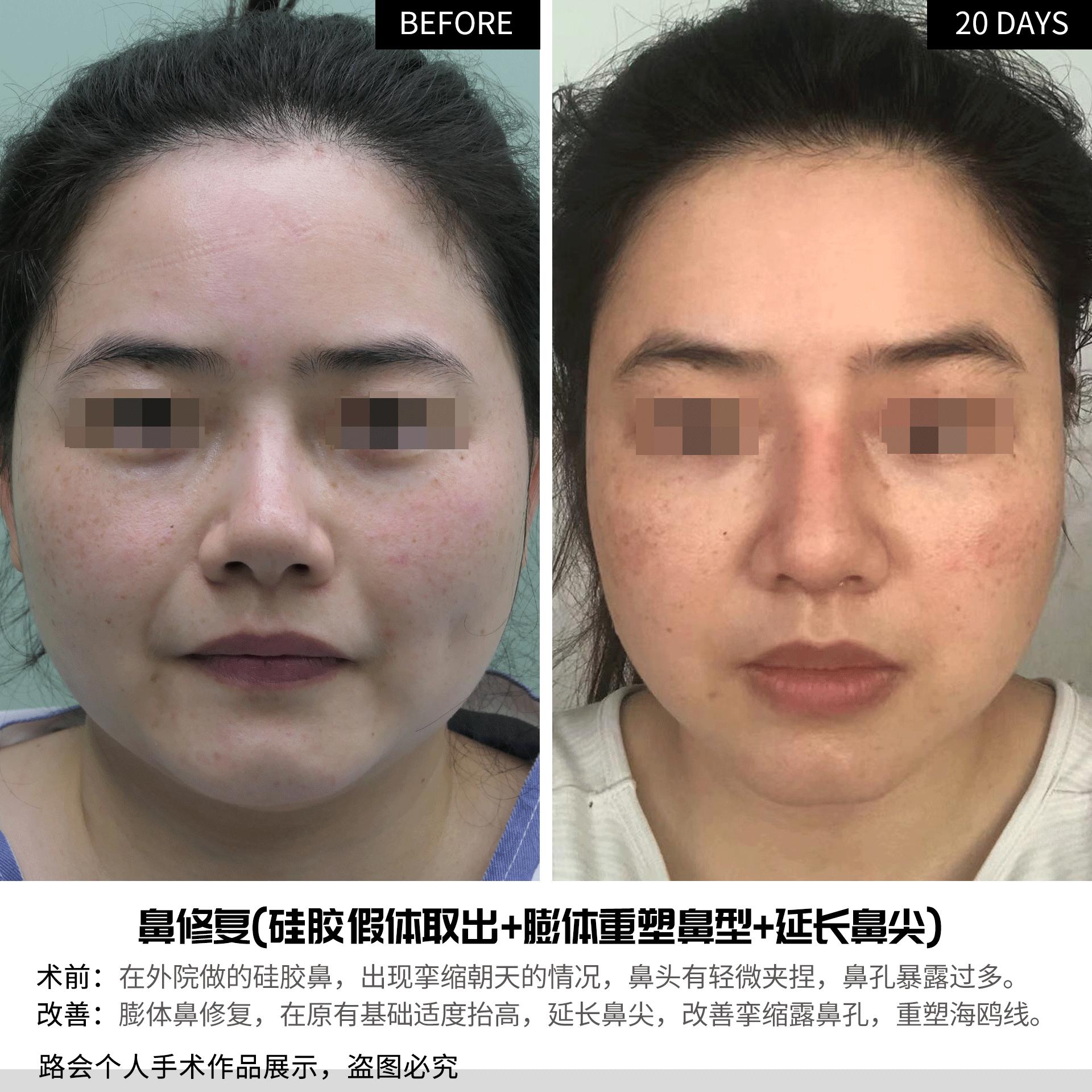 硅胶隆鼻5年歪了怎么修复,隆鼻10天歪了可以矫正吗