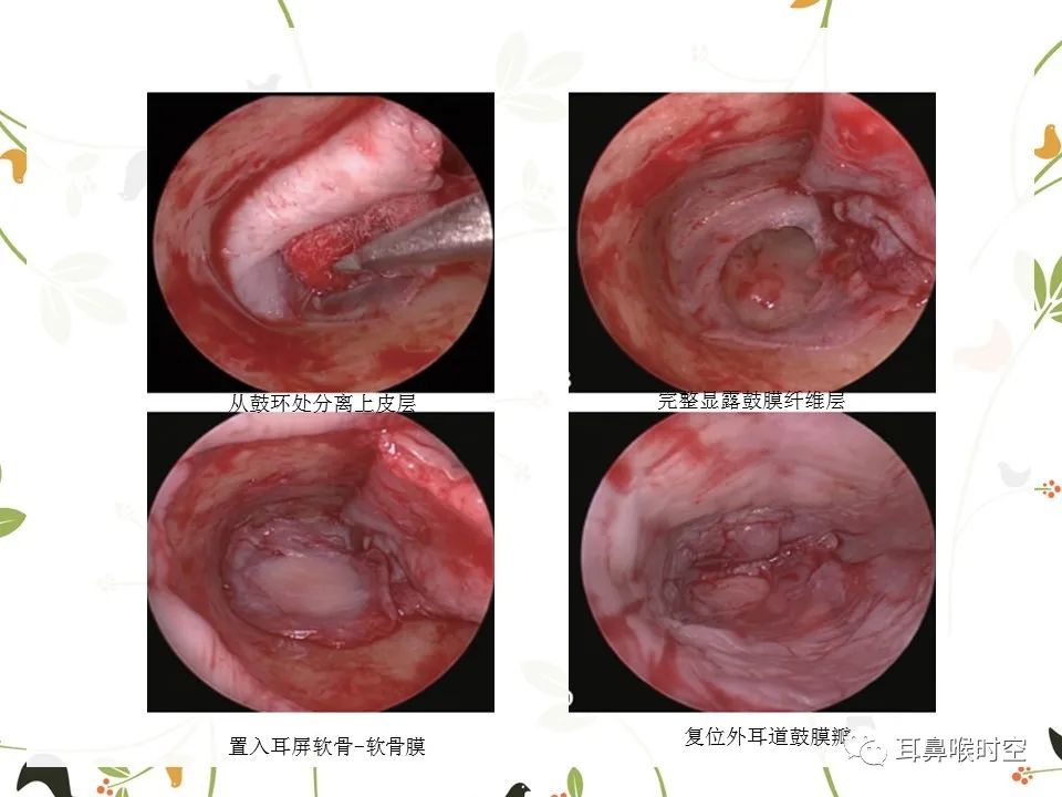 鼓膜可见穿孔,鼓膜穿孔听力下降能恢复吗