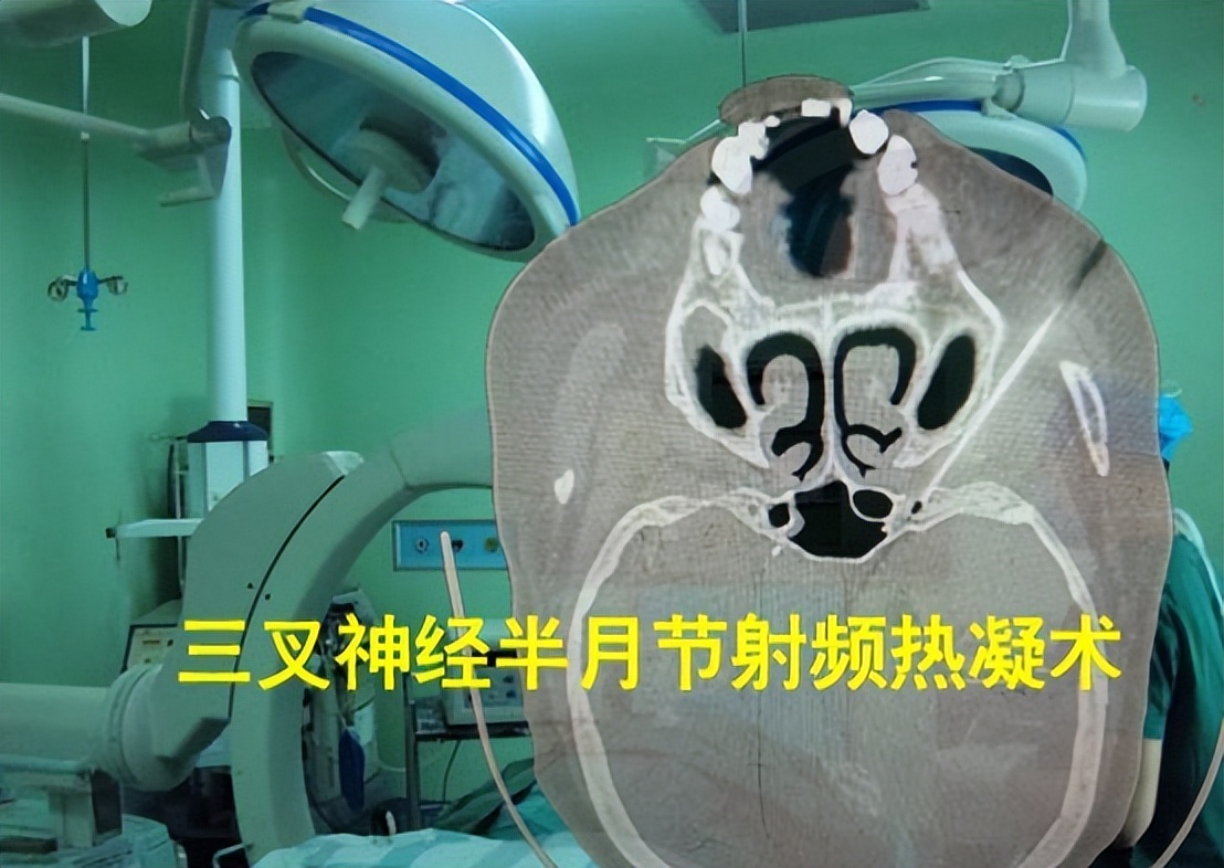 三叉神经痛伽玛刀可以维持多久,三叉神经痛伽玛刀有哪些副作用