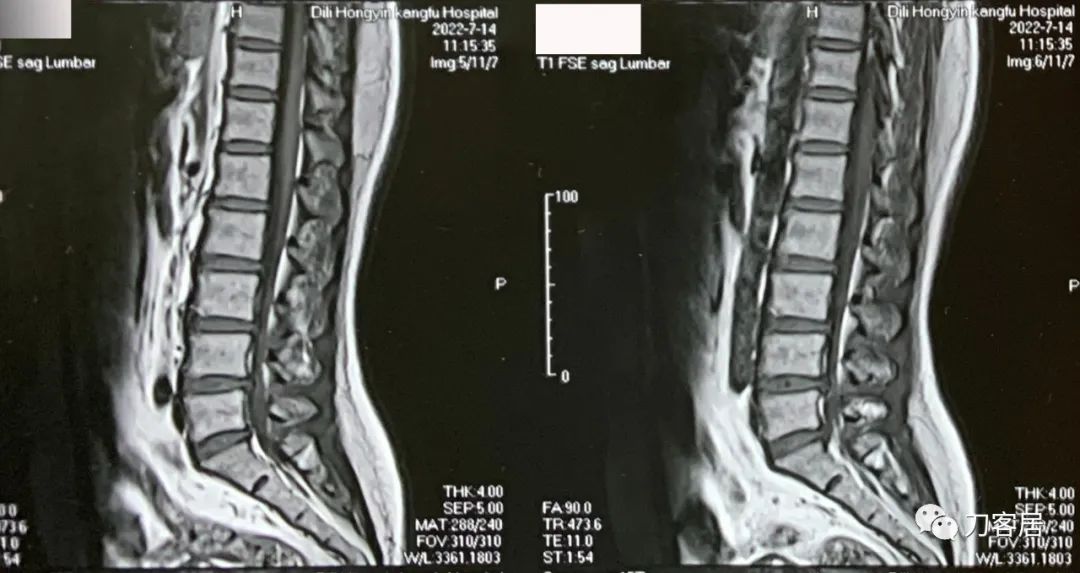 30岁女性左腿麻木是什么病的前兆,50岁的女人右腿经常麻是什么原因
