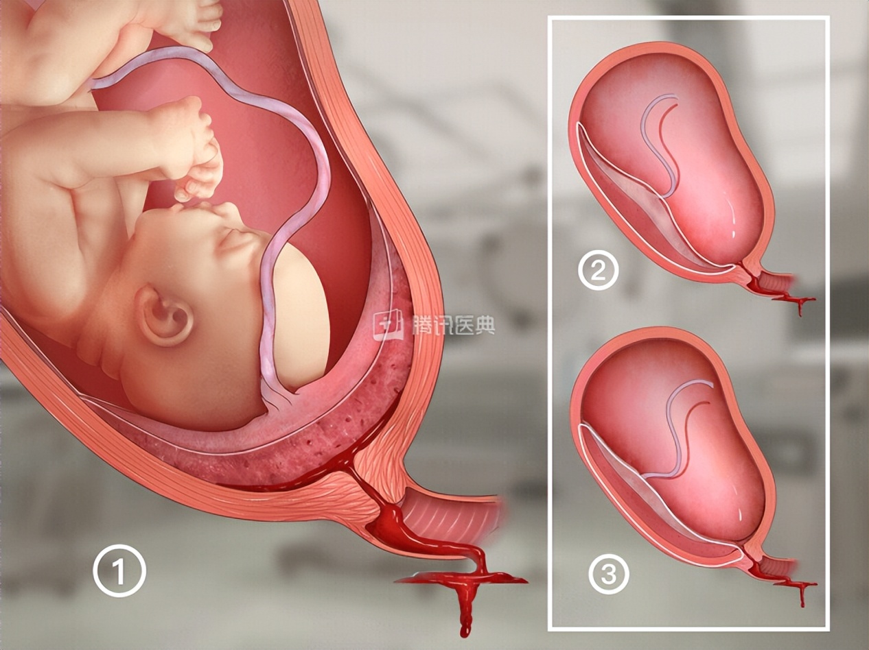 十月怀胎不易无特殊情况,孕三十一周前置胎盘怎么办