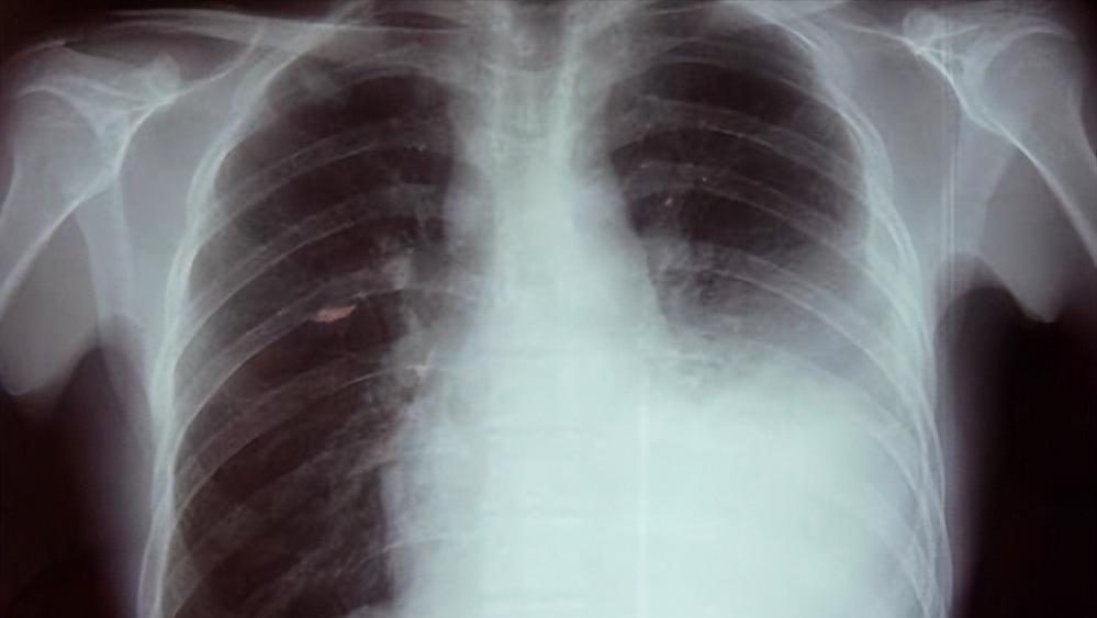 胸膜炎的胸痛和肺癌的痛哪个严重,经常胸闷咳嗽是不是肺癌