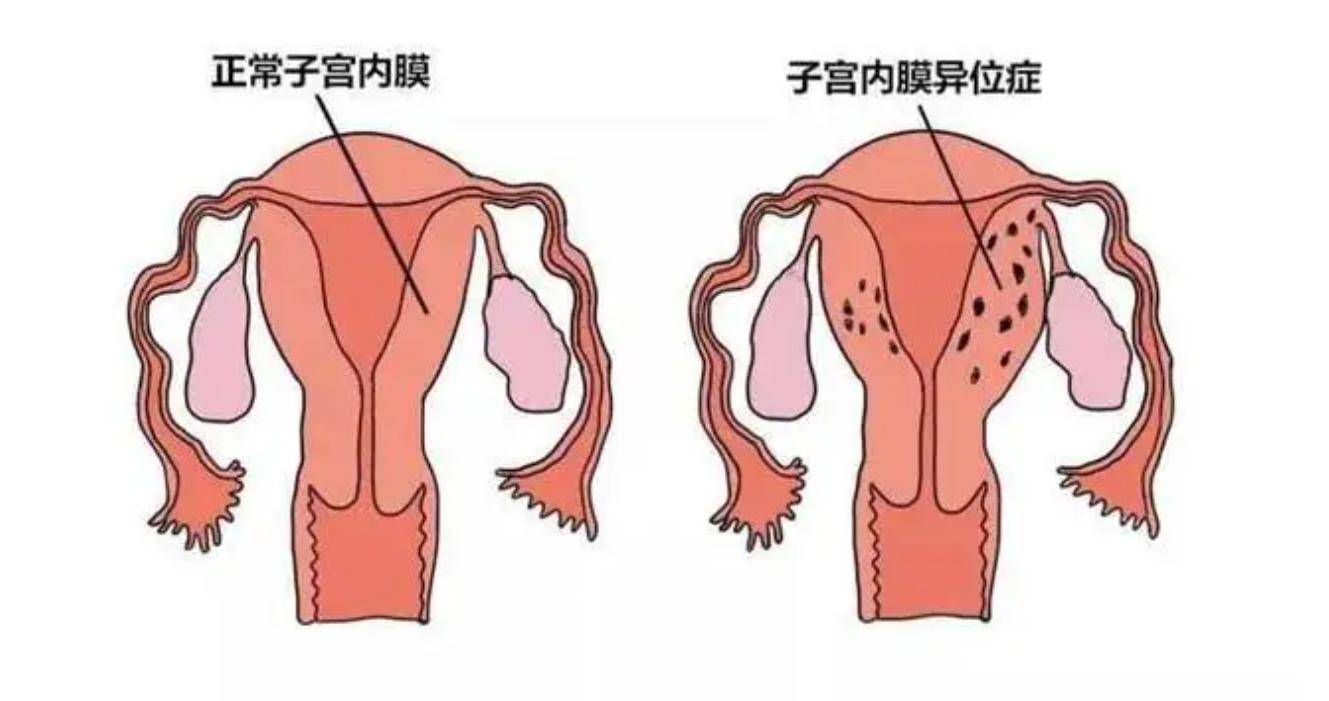 子宫内膜异位痛经中医能调理好吗,子宫内膜异位症痛经中药治疗方向