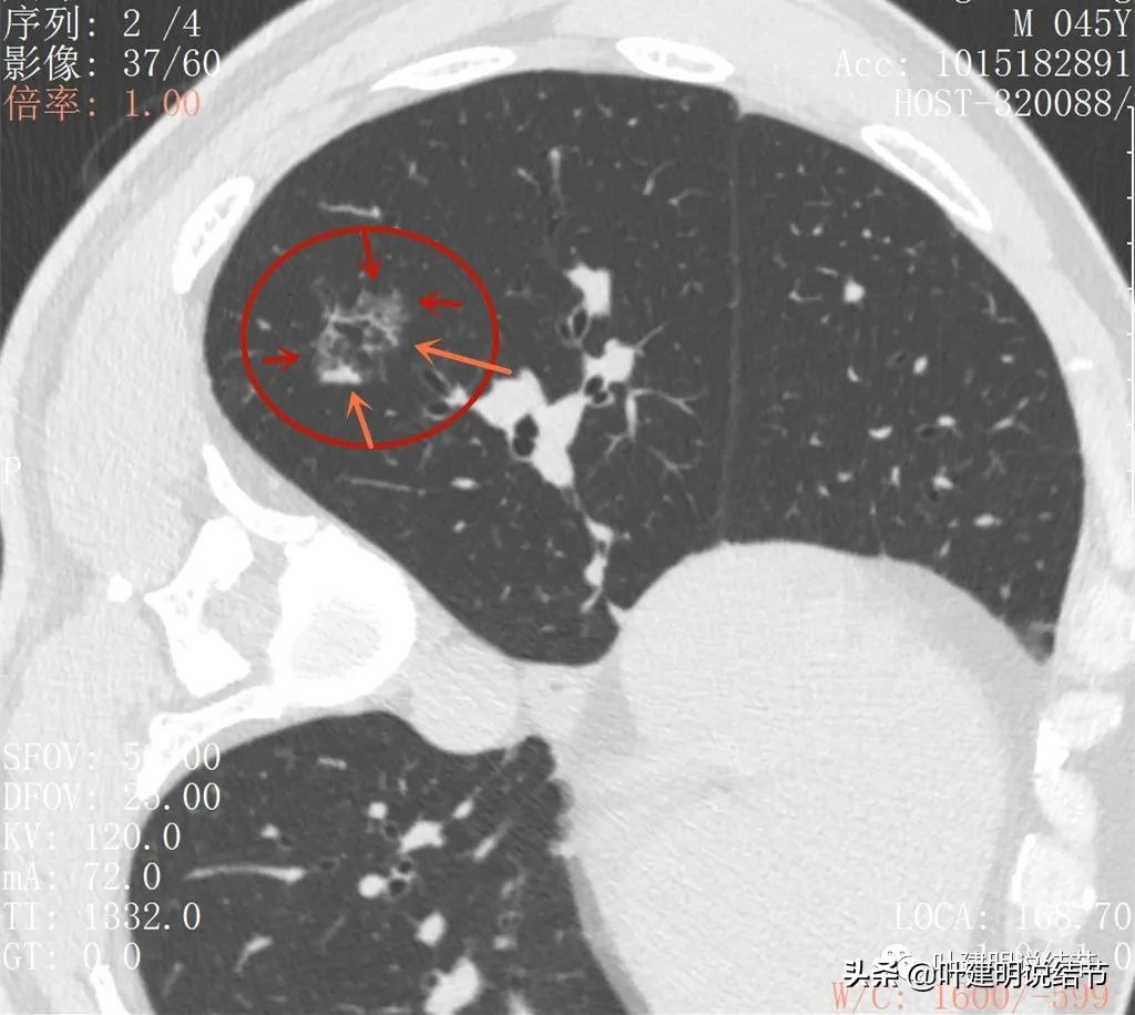 肺蜂窝状改变是肺癌吗,肺部陈旧灶与肿瘤怎么确诊