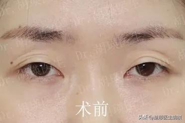 为什么很多人喜欢双眼皮,为什么男生喜欢双眼皮的女孩