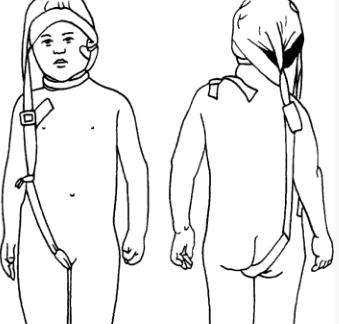 先天性斜颈偏颌,先天性肌性斜颈头偏怎么办