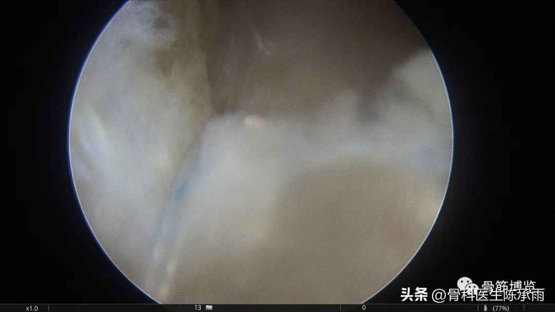 髌骨脱位软骨剥离怎么治疗,半月板撕裂游离体