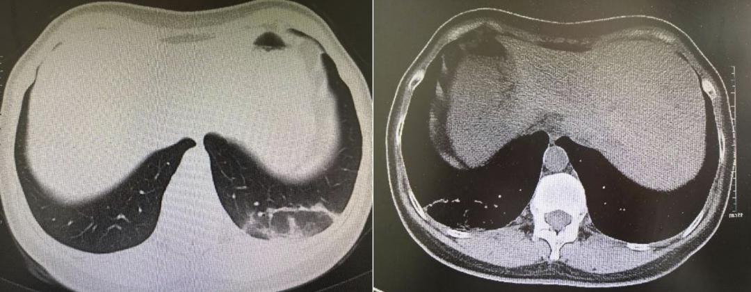 妇女高烧反复查不出原因,女子不明原因低热