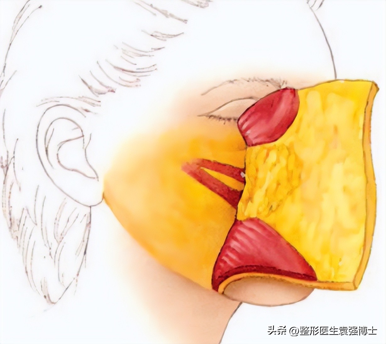 做拉皮手术前一定要明白这几点,医生不建议做拉皮手术