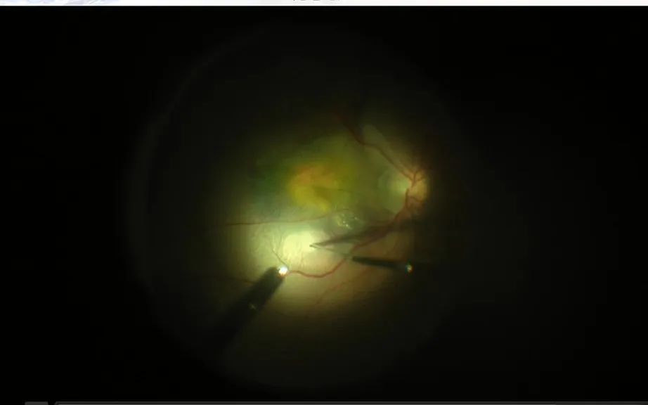 视力模糊眼前有黑影,眼前看到黑影滚动视力差怎么回事