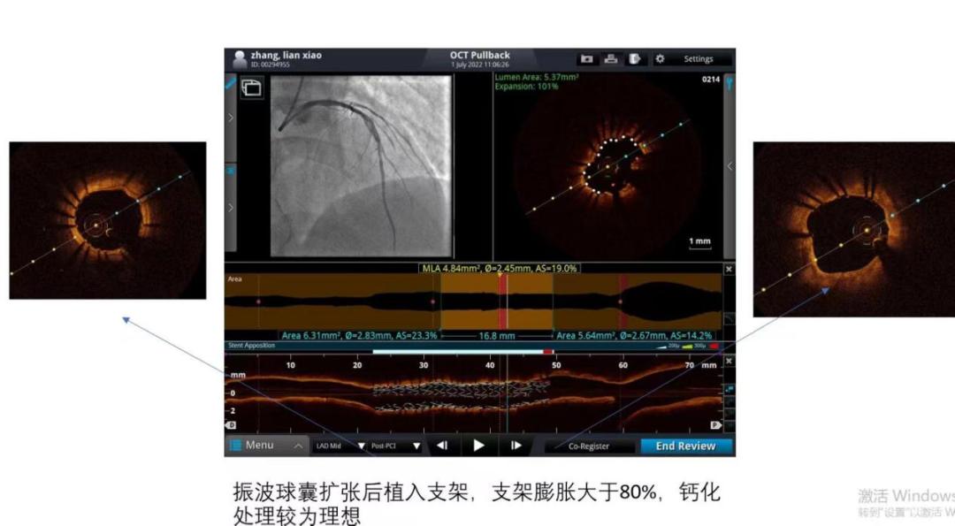 天津oct冠脉介入治疗,oct检查为冠心病诊治带来的启示