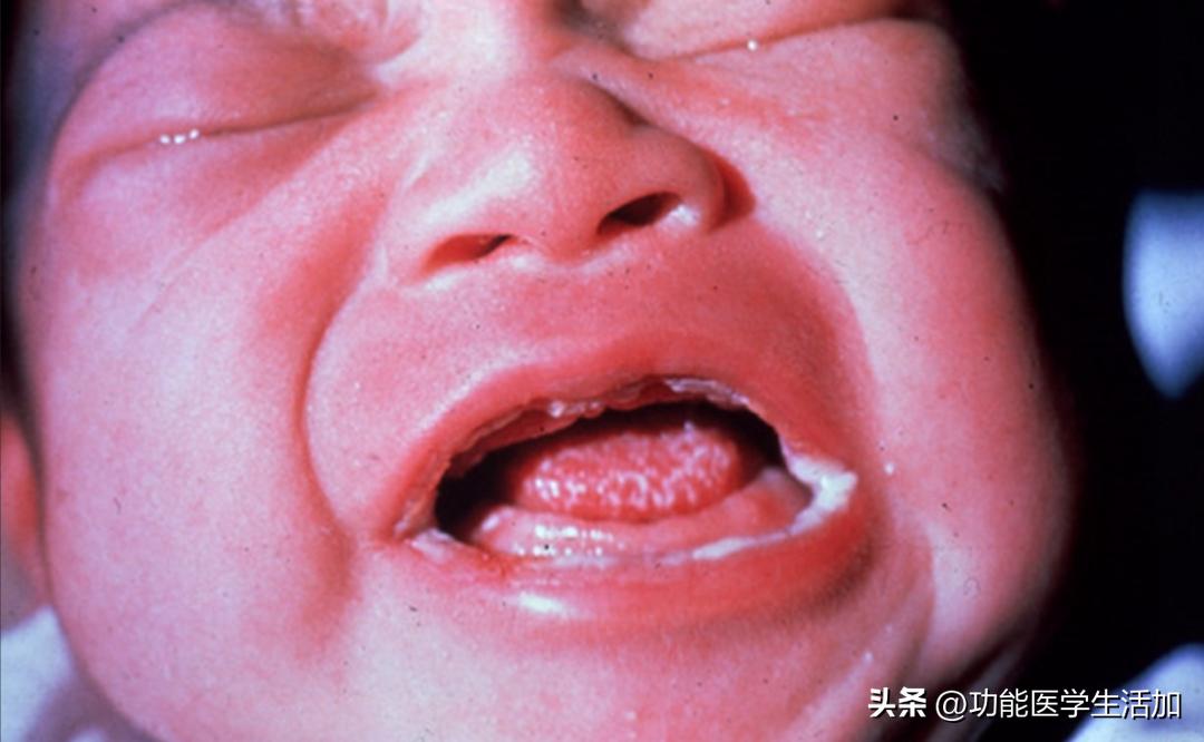 念珠菌优势生长什么意思,念珠菌过度生长对食道有什么影响