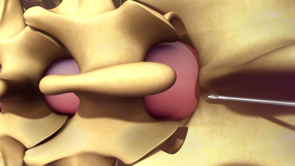 从腰部打麻药属于全麻吗,腰部打了麻醉药后会出现腰疼吗