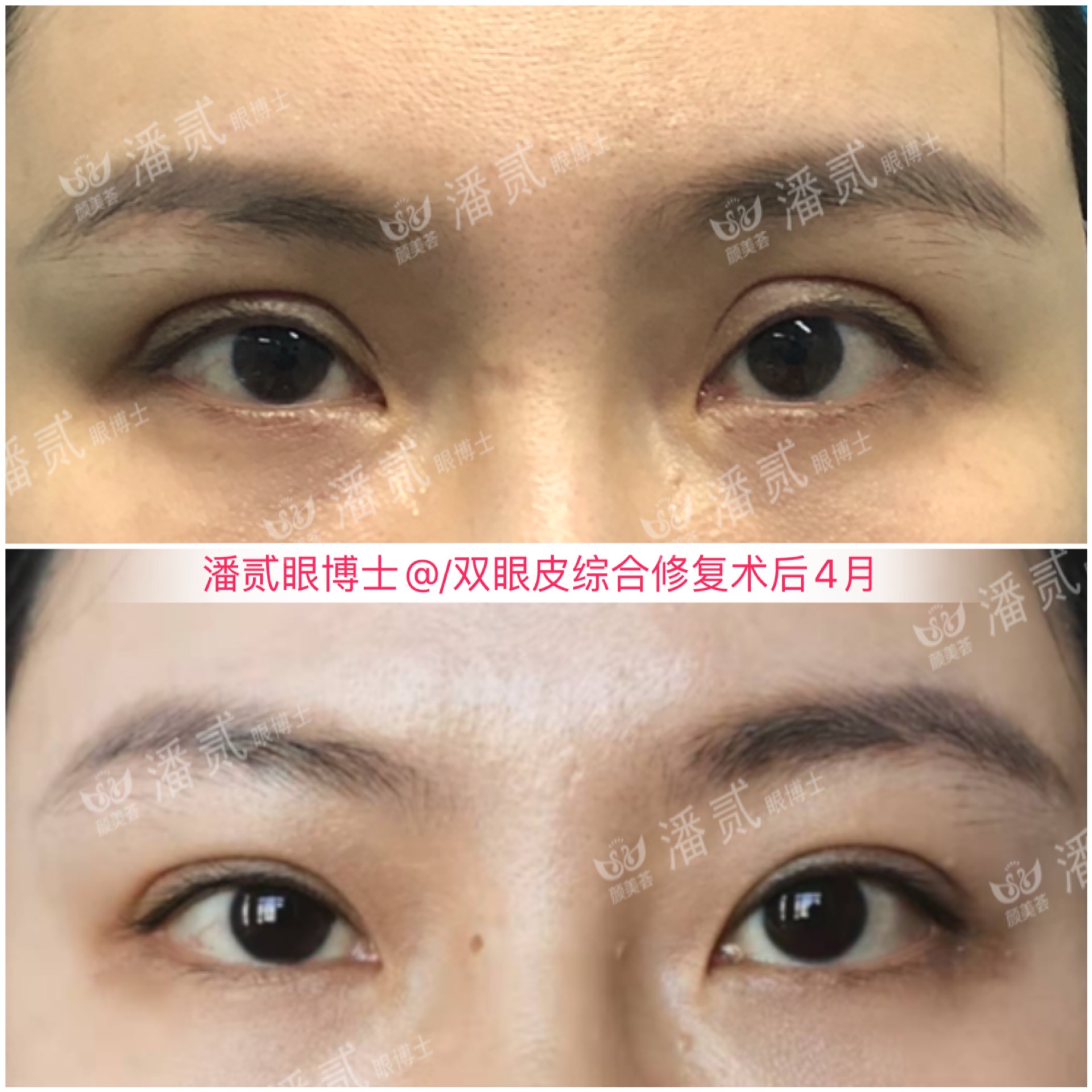 千万别被网红宽双眼皮*脑洗**了，对眉骨高眼窝深邃的人可能是灾难