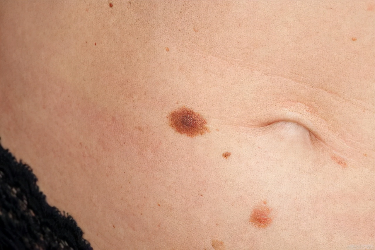 人为什么会长老人斑？红霉素软膏可以去除老人斑？本文告诉你真相