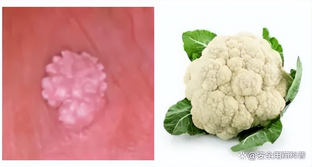 身上的四种疣,身上有很多种疣怎么治疗