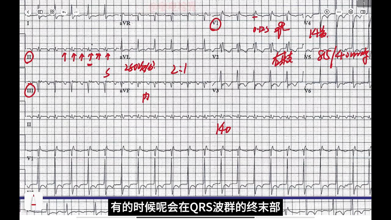 心电图病例分析-颈动脉窦受压改变房扑下传比例#执业医师考试