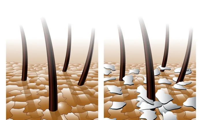 头皮屑与菌群有关，科学的去屑建议