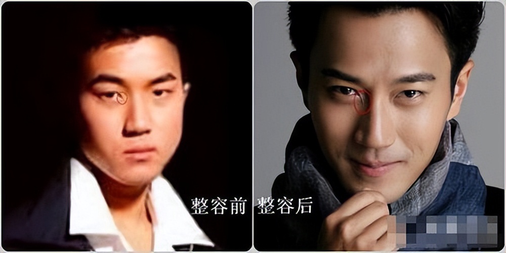 怎么不整容就能成为小v脸,不用整容也能变v脸吗