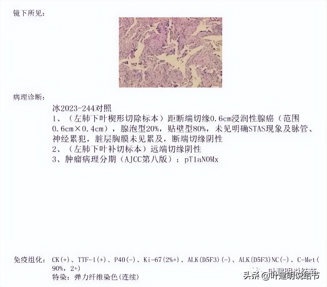 辽宁省肺结节手术哪家医院好,辽宁肺结节手术医院