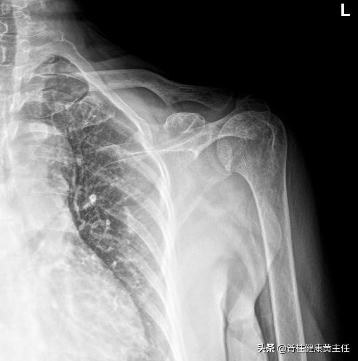 老年人肩痛，一定是肩周炎的原因吗？医生：鉴别和治疗说清楚