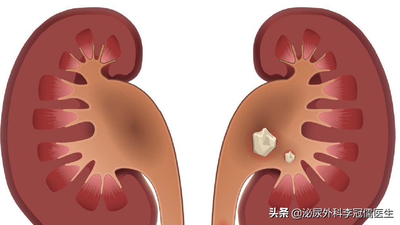 怎样能彻底根治尿结石,尿路结石怎么快速缓解尿意