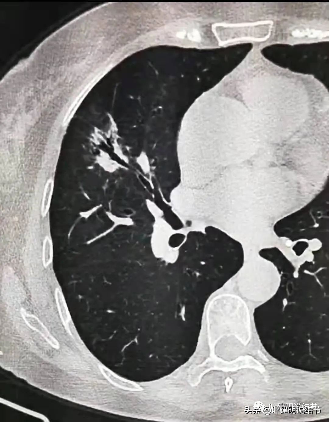 肺穿刺活检良性,肺穿刺活检容易形成气胸吗