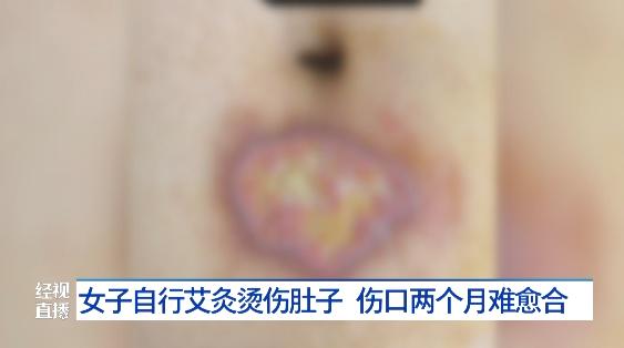 肚子上被烫出一个泡,女人肚子被烫伤