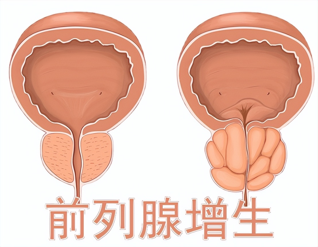 他达拉非4元一片，改善力不从心，保护血管内皮，抗前列腺增生