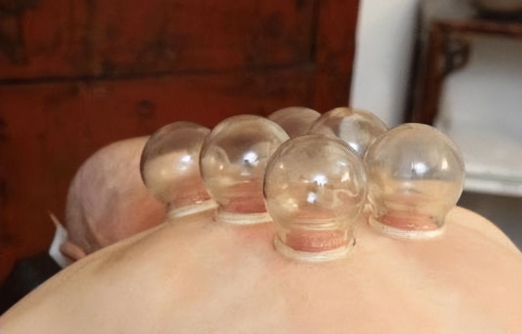 拔火罐吸出来的是湿气还是毒素,拔火罐吸出来的瘀血是体内毒素吗