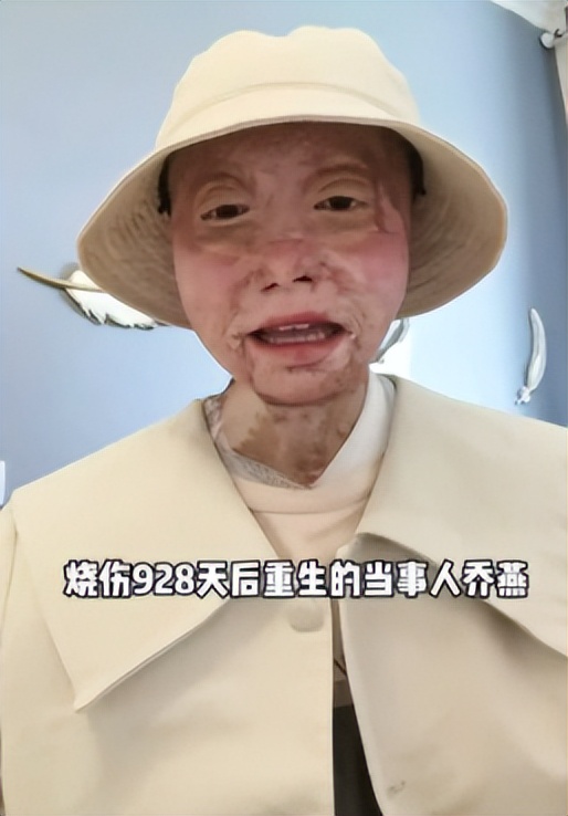 24岁少女烧伤变沧桑老人,12次手术涅槃重生:不被命运摆布的坚强