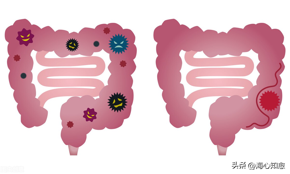 肠癌放疗后尿频是怎么回事,肠癌放疗后遗症有哪些症状