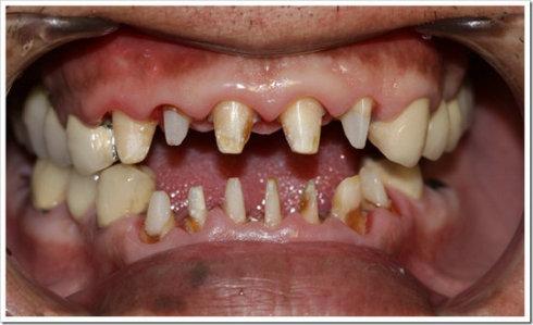 牙龈萎缩生理性萎缩一年缩多少,牙龈萎缩怎么办教你一招自愈