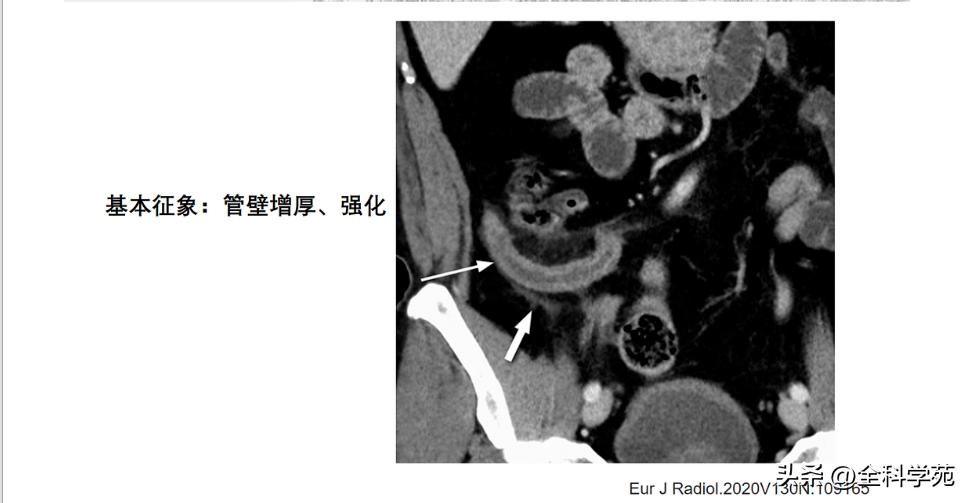 阑尾炎的讲解,关于阑尾炎的讨论总结